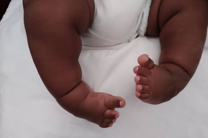 Clubfoot Surgeons Urge Early Care To Prevent Disability