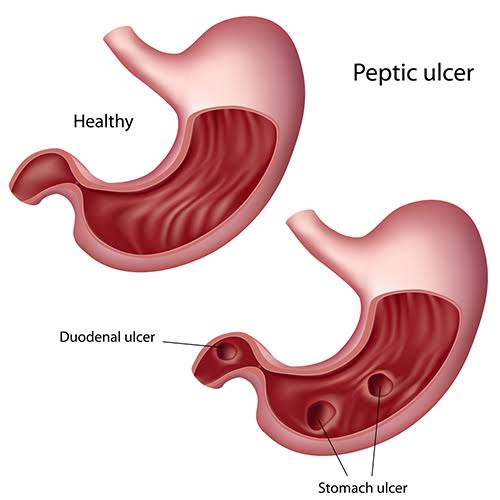 Peptic Ulcer Disease in Children and Long-Term Health Risks